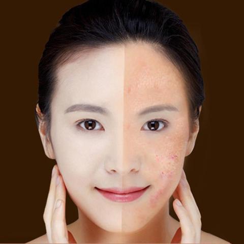 Blue Light Therapy Acne Laser Pen Soft Scar Wrinkle Removal Treatment Device Skin Care Beauty Equipment - Image 8